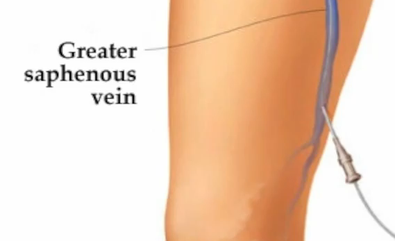 Treating Varicose Veins